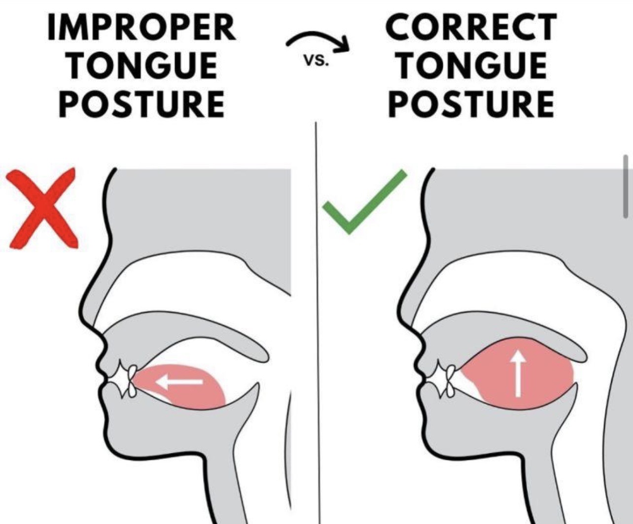 Proper tongue posture